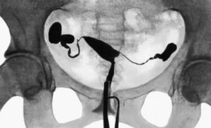 Проходимость маточных труб