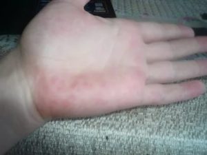 На ладонях образовались покраснения, болят при нажатии