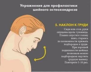 Головокружение при наклонах головы и поворотах