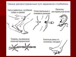 Риск заражения столбняком дома