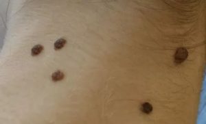 Очень мягкие родинки в паху