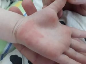 Сыпь и зуд до крови у ребенка