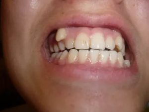 Удалили клык