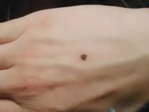 Удаленная родинка между пальцев мокнет