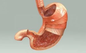 Тяжесть в желудке и синдром манной крупы