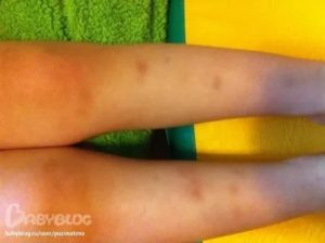 Синяки на ногах у ребенка