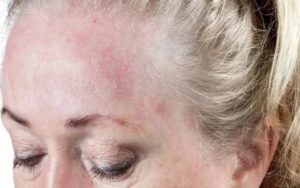 Шелушение на лбу