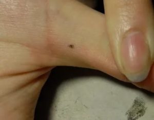 Удаленная родинка между пальцев мокнет