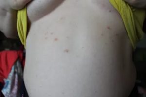 Сыпь под молочными железами, на шее, животе