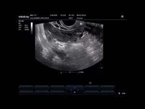 Киста желтого тела или внематочная беременность