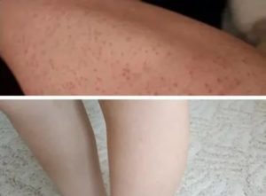 Темные пятна от вросших волос