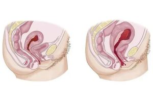 Первый секс после родов. Выделения