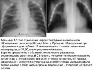 Правый корень расширен при Рентген обследование