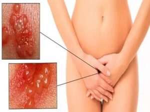 Жжение и гиперемия во влагалище