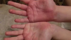 На ладонях образовались покраснения, болят при нажатии