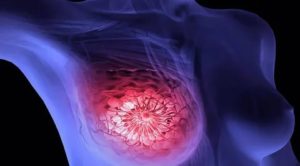 Фиброзно кистозная мастопатия, болезнь Минца