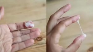 Белые густые выделения без запаха, боли в районе левого яичника