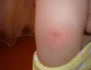 Уплотнение на бедре ребенка