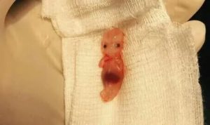 Срок беременности 7-8 недель. Начались кровянистые выделения