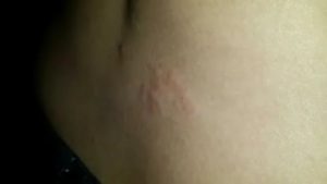 Сыпь на спине, боль в боку