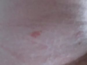 Пятна на теле похожи на засос