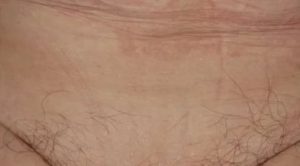 Покраснение и рубцы в паху