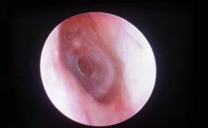 Обезболивание при перфорации перепонки уха