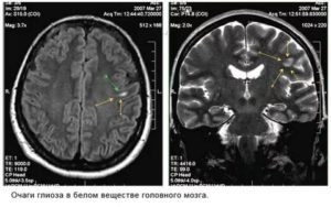 Нейройнфекция, очаги глиоза в лобной доли