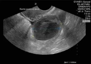 Киста желтого тела или внематочная беременность