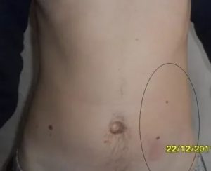 Слева от пупка ноющее уплотнение