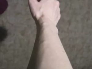 Шарик на вене