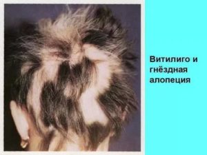 Белый клок волос на голове