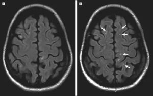 Нейройнфекция, очаги глиоза в лобной доли