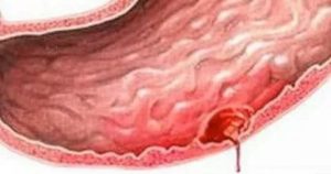 Острая язва антрального отдела желудка