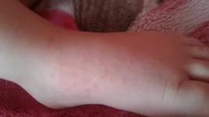 Аллергия у ребенка только между ножек