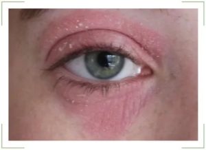 Красное пятно на нижнем веке
