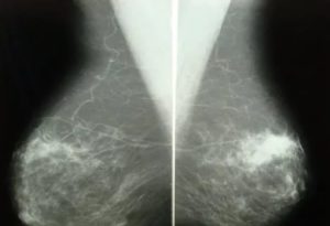 Фиброзно кистозная мастопатия, болезнь Минца