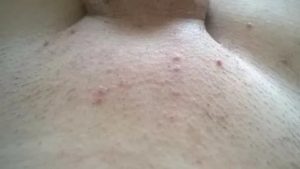 Ранки на лобке