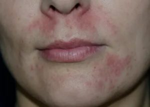 Использование пульмикорта и периоральный дерматит у ребенка