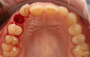 Удалили клык