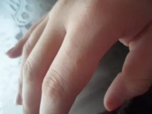 Опасная от родинка на мизинце ноги