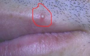 Узелки под головкой полового члена