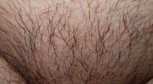 Зуд и шелушение на лобке и голене