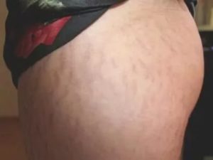 Сильное жжение кожи внизу живота и ляшках до колен