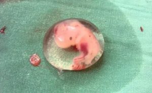 ОК после замершей беременности