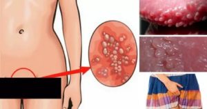 Жжение и гиперемия во влагалище