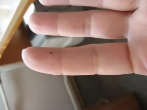 Опасная от родинка на мизинце ноги