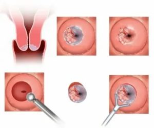 Месячные после конизации шейки матки