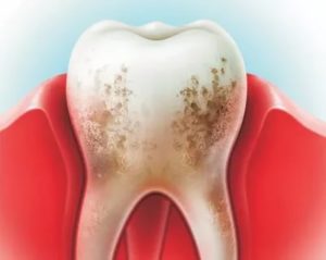 Кровоточивость на месте разрушенного зуба