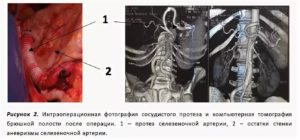 Удаление селезенки, аневризма селезеночной артерии